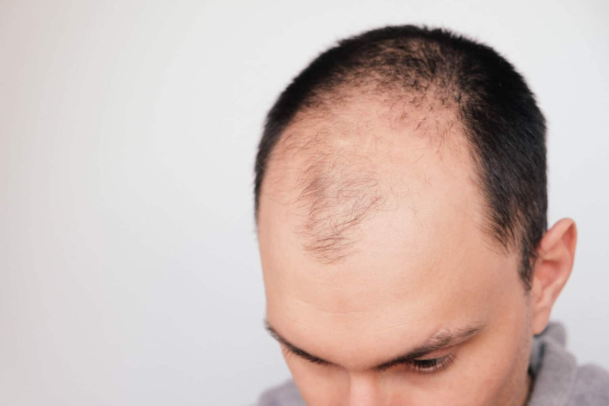 Beyond Genetics: Lifestyle Factors Contributing to Hair Loss